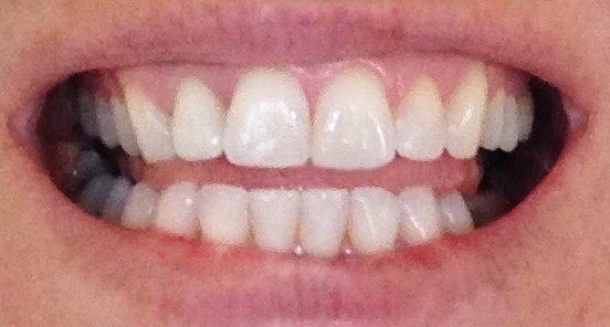 Invisalign-After